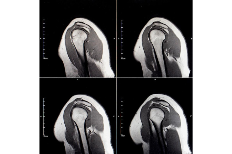 Shoulder MRI